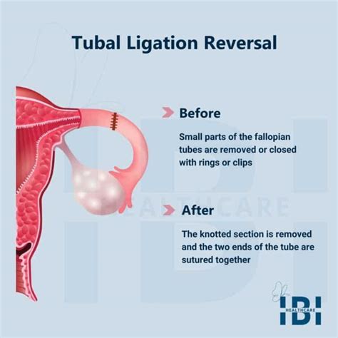 cheapest way to get pregnant after tubal ligation