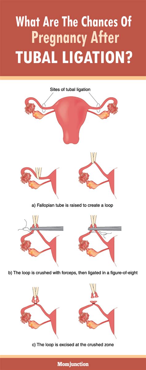 how likely are you to get pregnant after tubal ligation