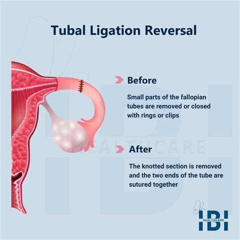 how long after tubal ligation can tubes grow back